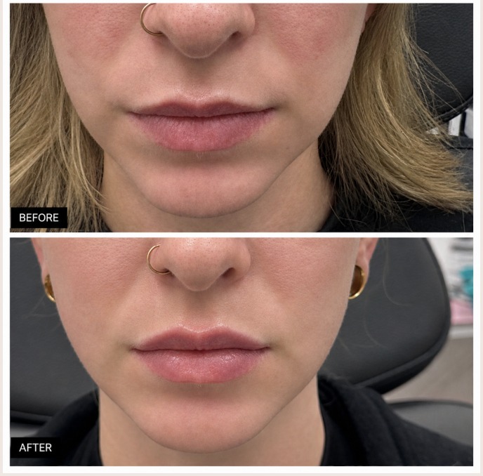 How Wellness IV Bar Creates Natural-Looking Lip Enhancement